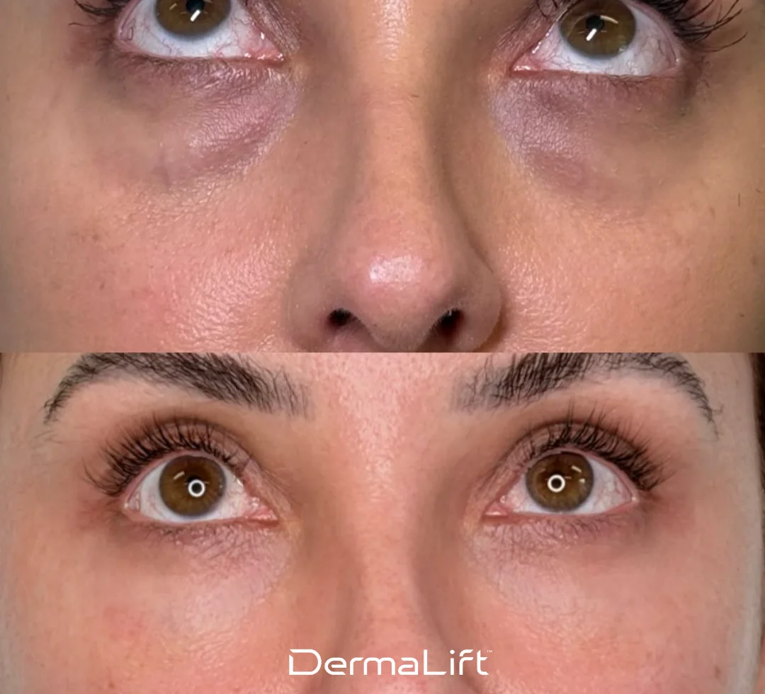 DermaLift Before And After