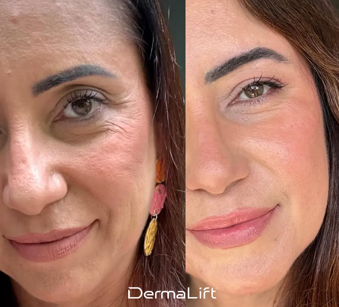 DermaLift Before And After