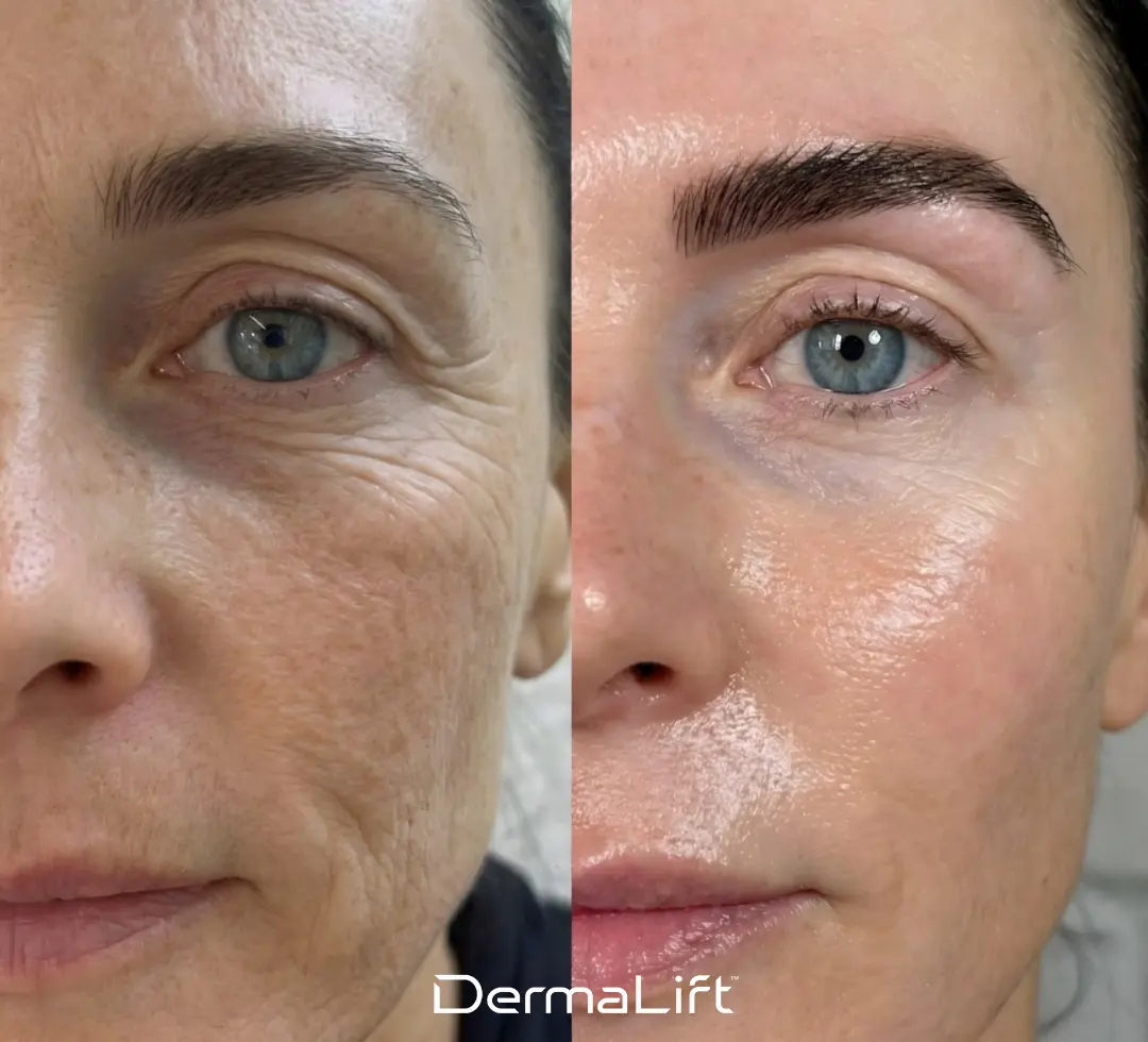 DermaLift Before And After
