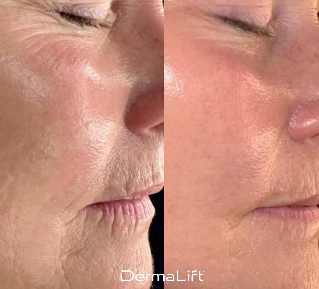 DermaLift Before And After