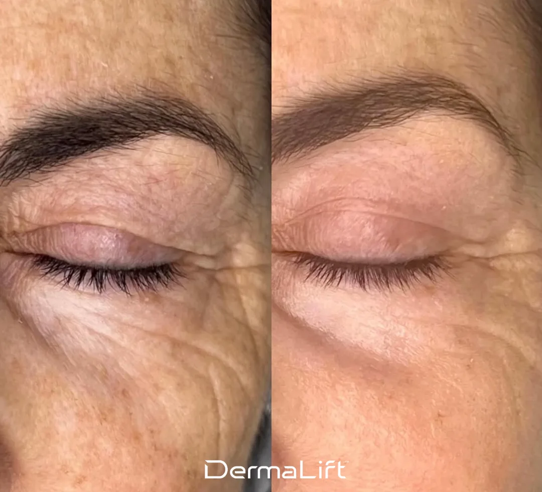 DermaLift Before And After