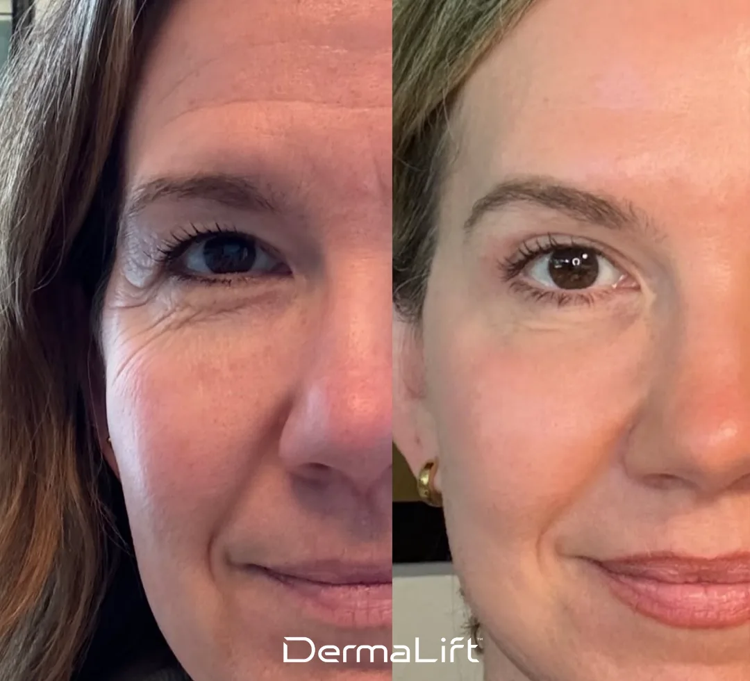 DermaLift Before And After