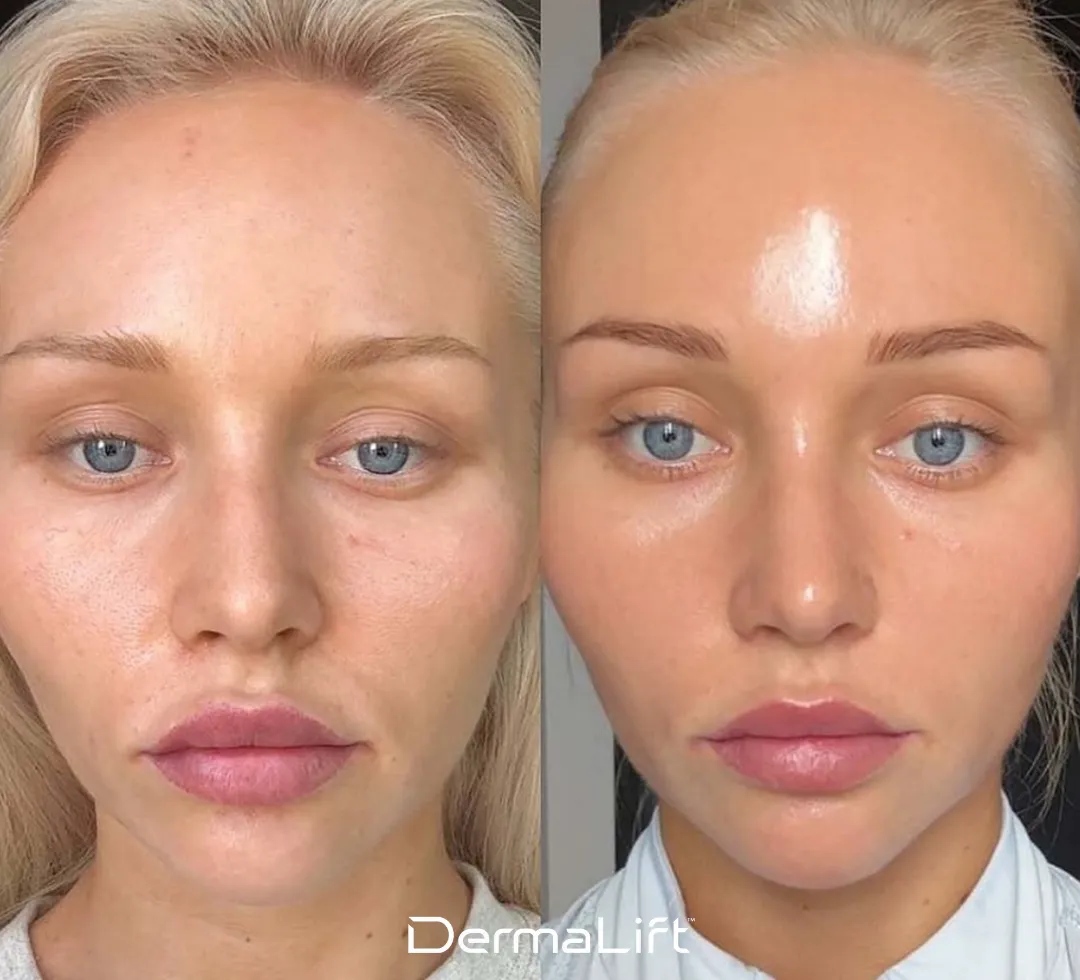 DermaLift Before And After