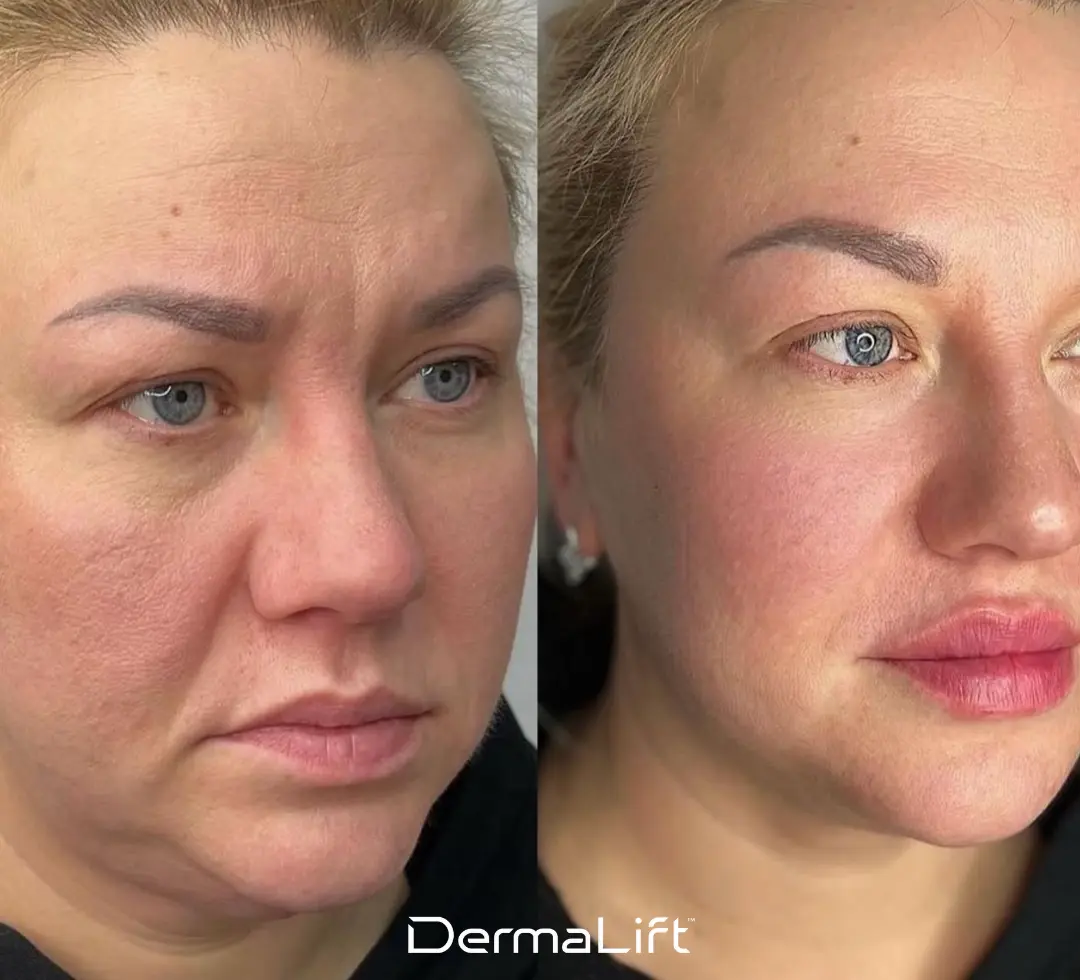 DermaLift Before And After