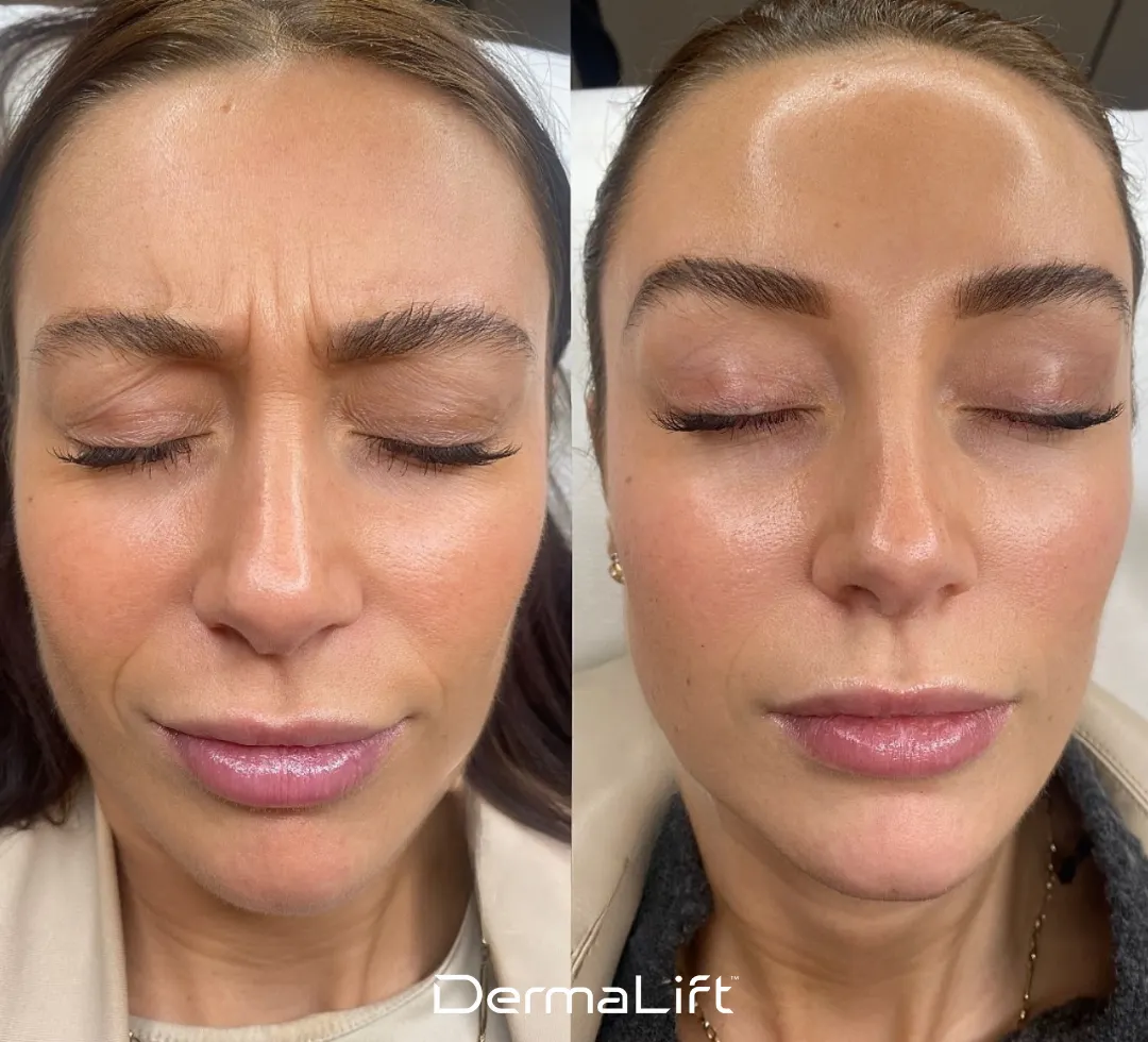 DermaLift Before And After