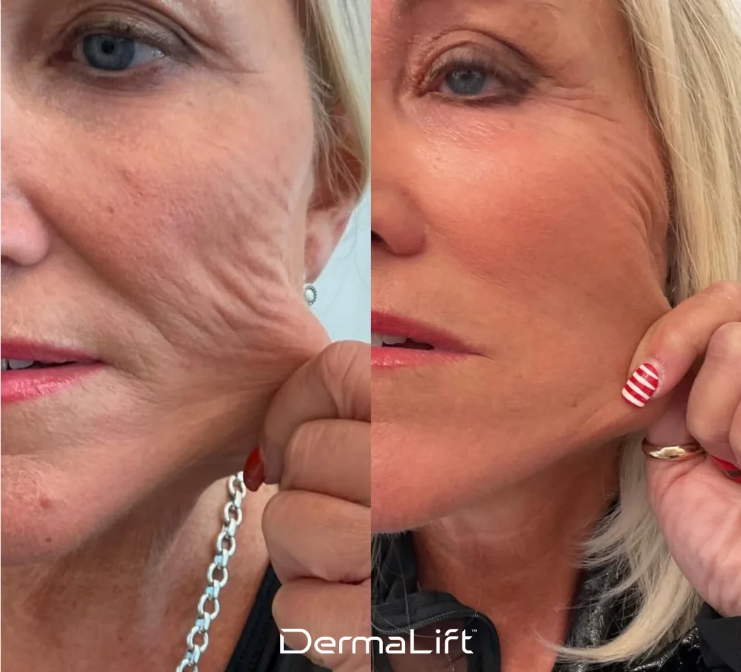 DermaLift Before And After