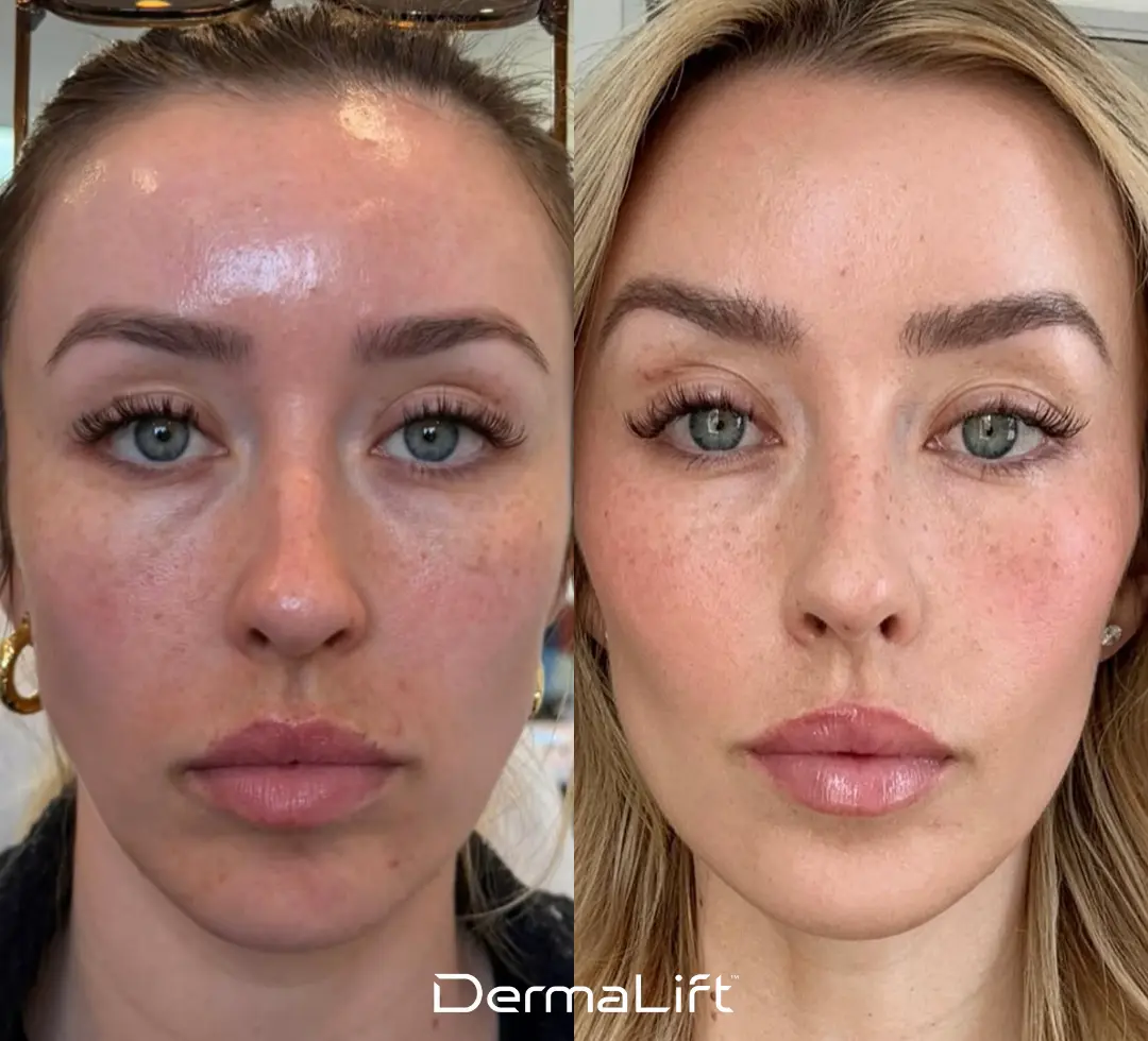 DermaLift Before And After