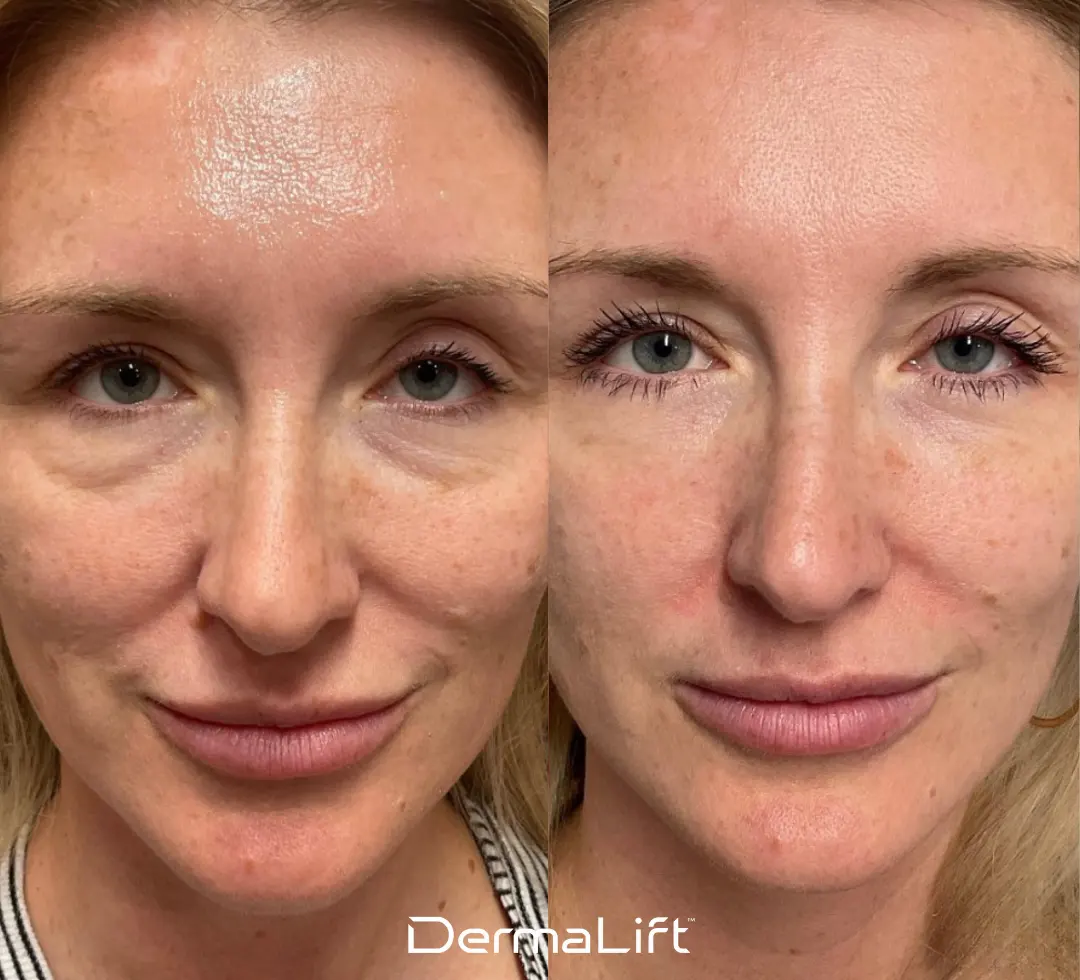 DermaLift Before And After