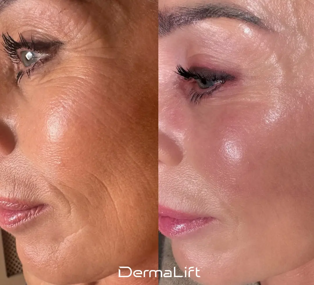 DermaLift Before And After